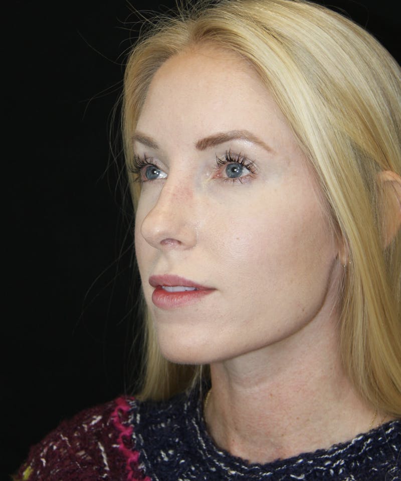 Rhinoplasty Before & After Gallery - Patient 182104574 - Image 7