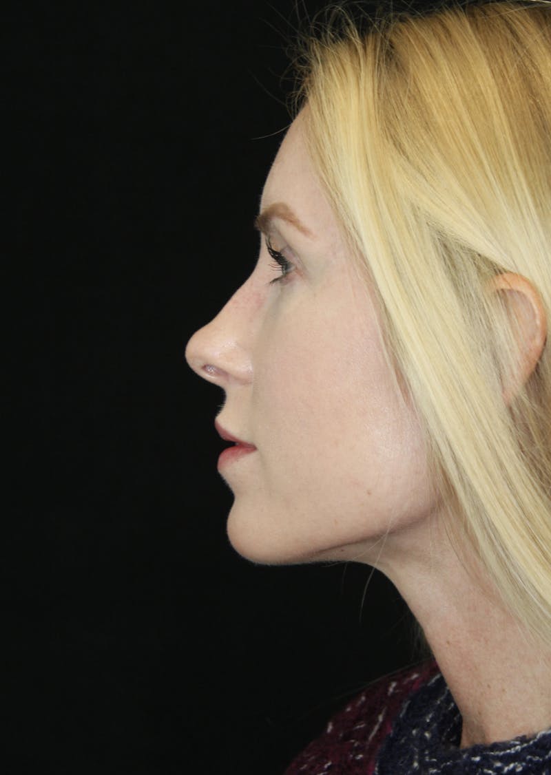 Rhinoplasty Before & After Gallery - Patient 182104574 - Image 9