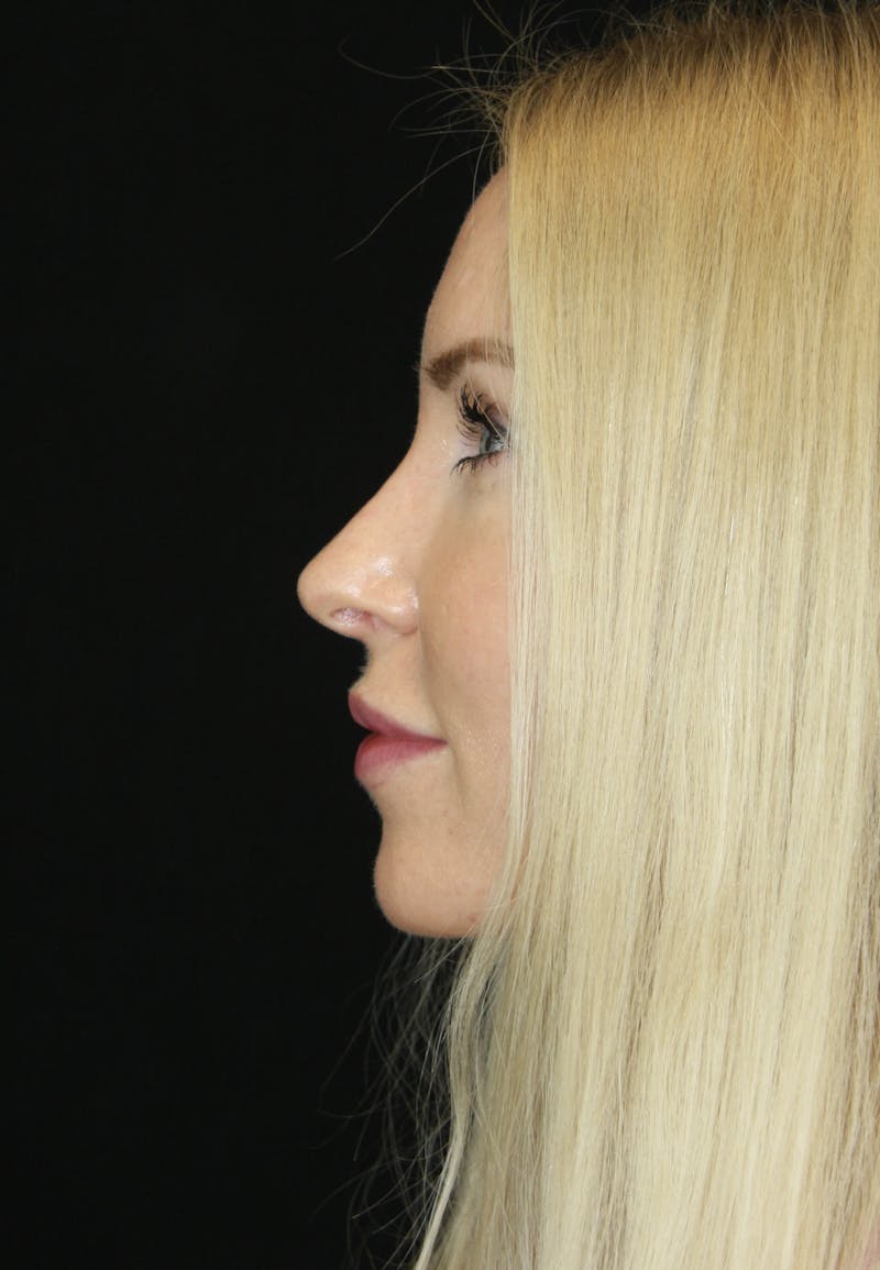 Rhinoplasty Before & After Gallery - Patient 182104574 - Image 10