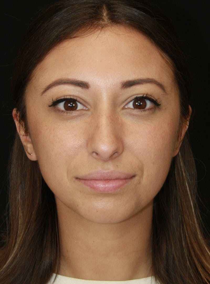 Rhinoplasty Before & After Gallery - Patient 182104661 - Image 1