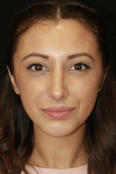 Rhinoplasty Before & After Gallery - Patient 182104661 - Image 2