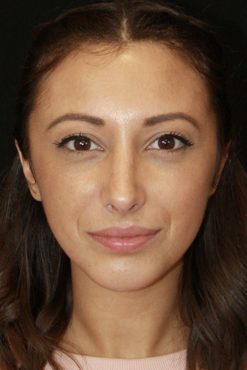 Rhinoplasty Before & After Gallery - Patient 182104661 - Image 2