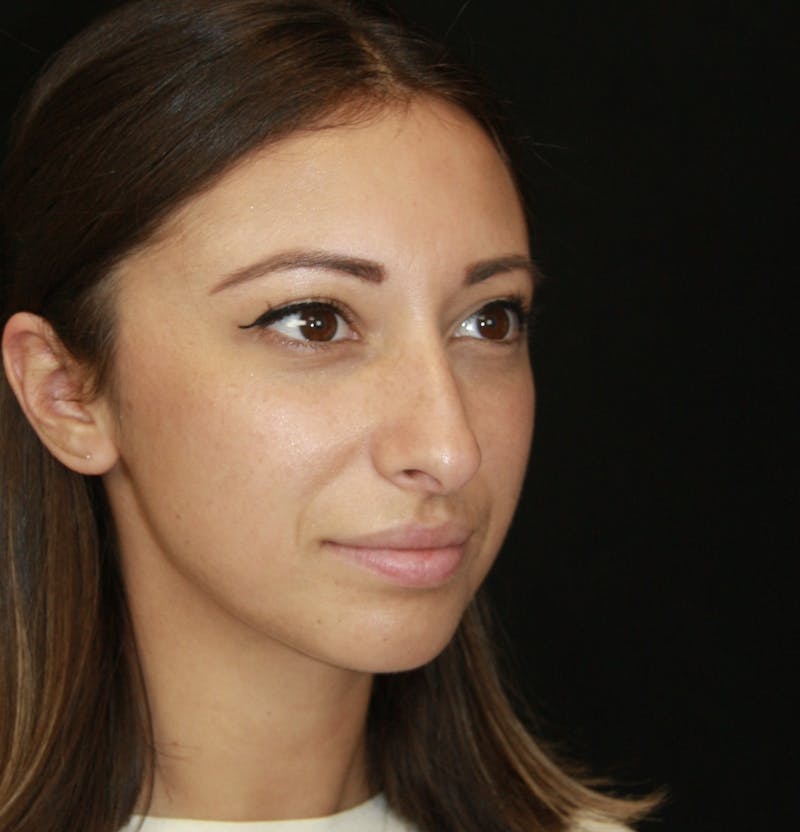 Rhinoplasty Before & After Gallery - Patient 182104661 - Image 3