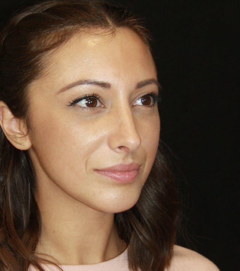 Rhinoplasty Before & After Gallery - Patient 182104661 - Image 4