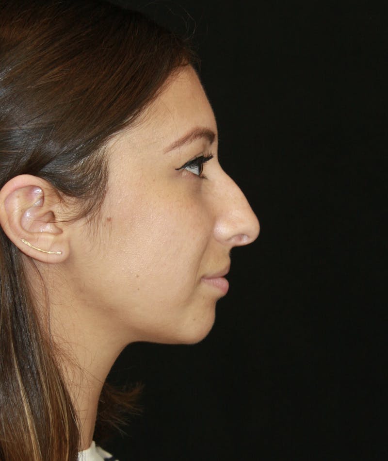 Rhinoplasty Before & After Gallery - Patient 182104661 - Image 5