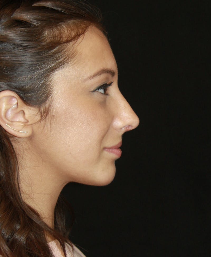 Rhinoplasty Before & After Gallery - Patient 182104661 - Image 6