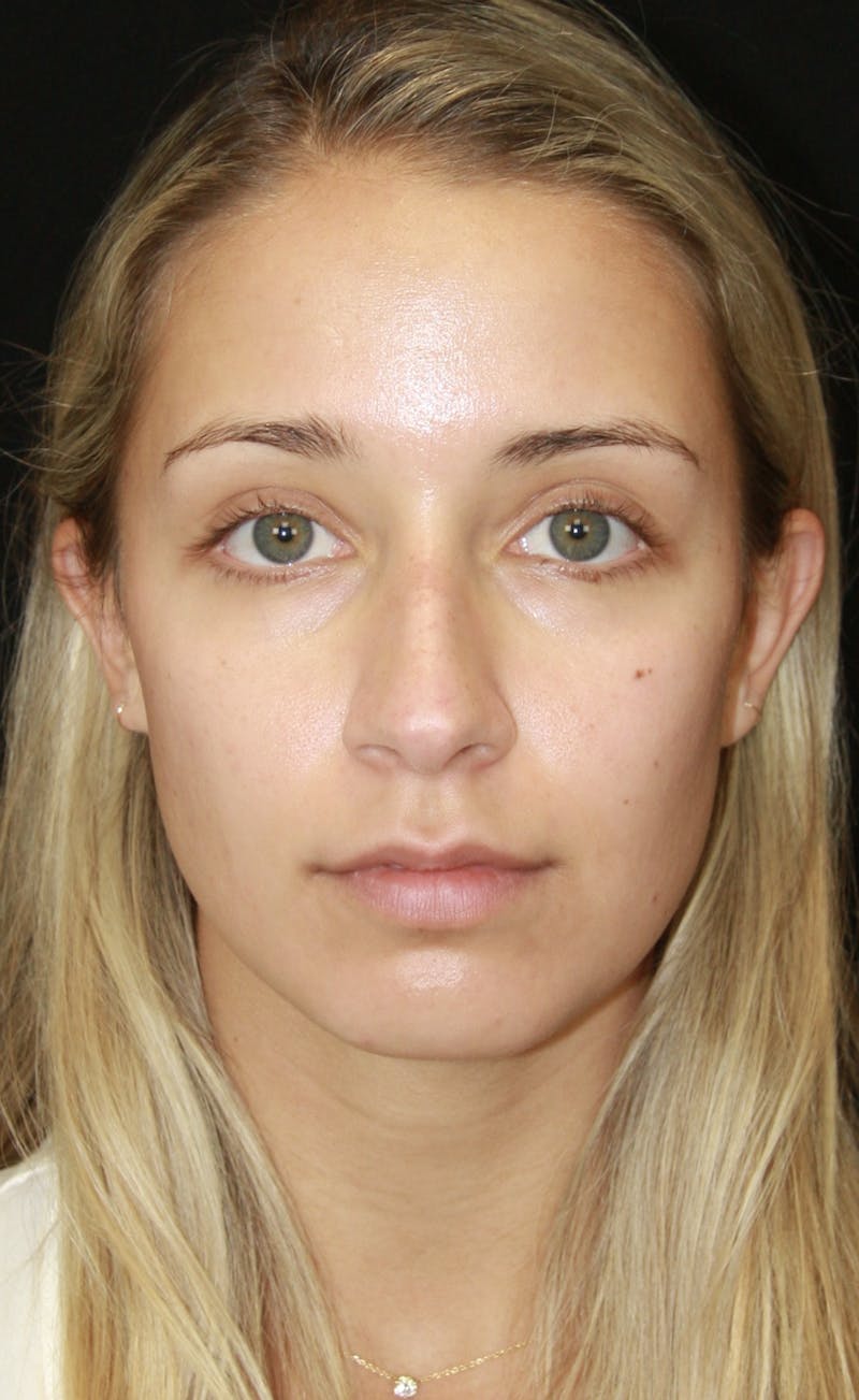 Rhinoplasty Before & After Gallery - Patient 182104680 - Image 1