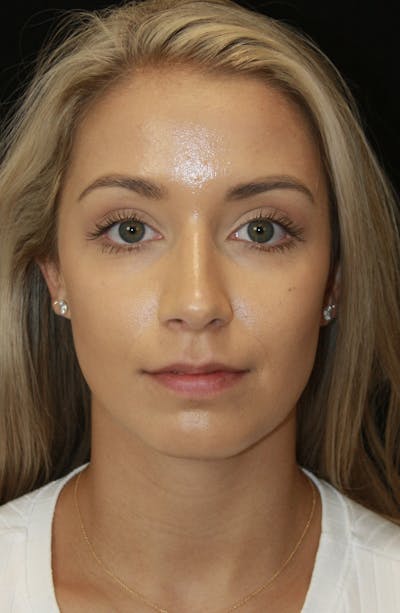 Rhinoplasty Before & After Gallery - Patient 182104680 - Image 2