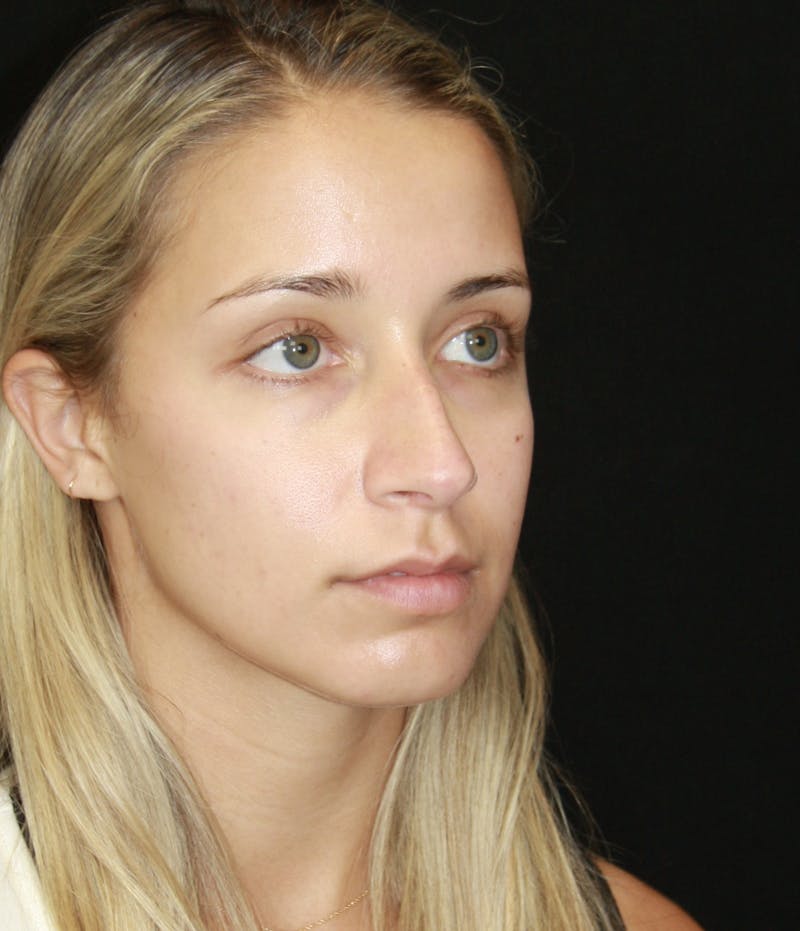 Rhinoplasty Before & After Gallery - Patient 182104680 - Image 3