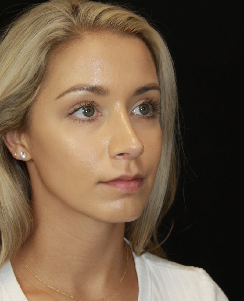 Rhinoplasty Before & After Gallery - Patient 182104680 - Image 4
