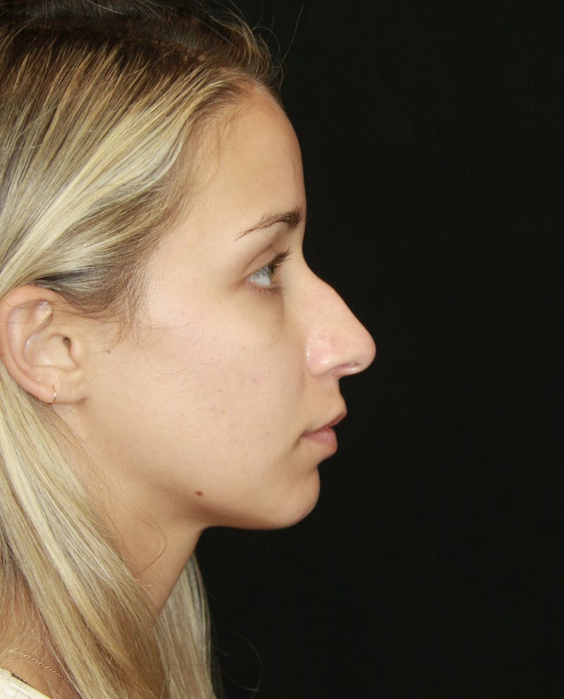 Rhinoplasty Before & After Gallery - Patient 182104680 - Image 5