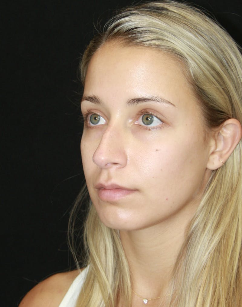 Rhinoplasty Before & After Gallery - Patient 182104680 - Image 7