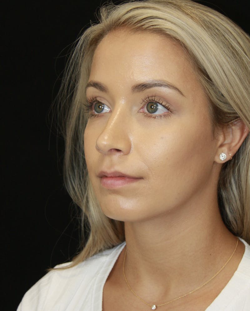 Rhinoplasty Before & After Gallery - Patient 182104680 - Image 8