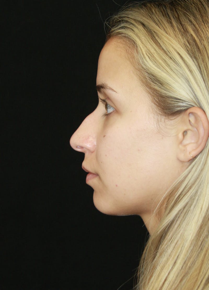 Rhinoplasty Before & After Gallery - Patient 182104680 - Image 9