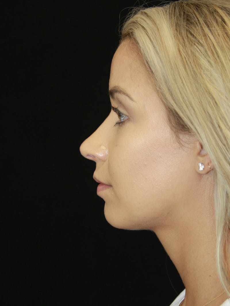 Rhinoplasty Before & After Gallery - Patient 182104680 - Image 10