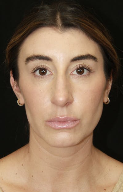 Rhinoplasty Before & After Gallery - Patient 182104693 - Image 1