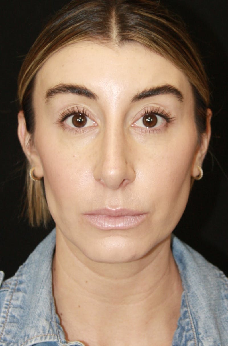 Rhinoplasty Before & After Gallery - Patient 182104693 - Image 2
