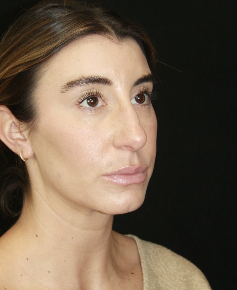 Rhinoplasty Before & After Gallery - Patient 182104693 - Image 3