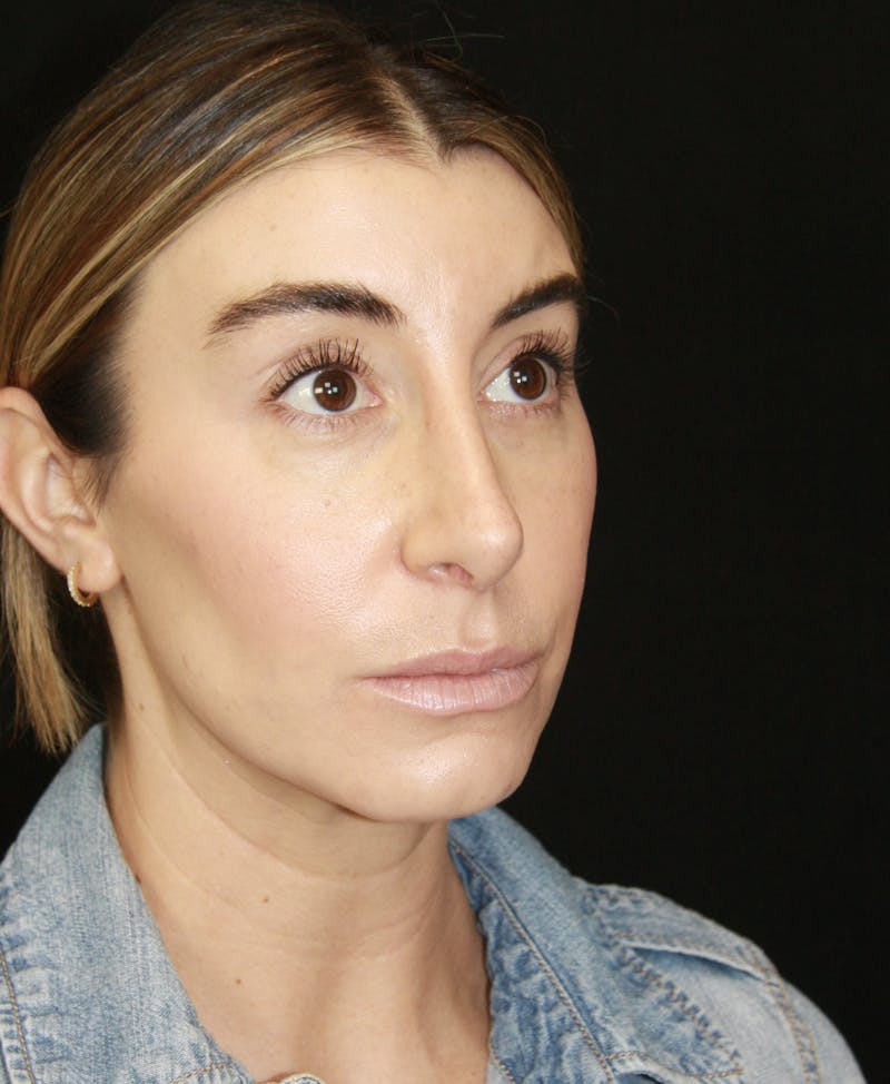Rhinoplasty Before & After Gallery - Patient 182104693 - Image 4