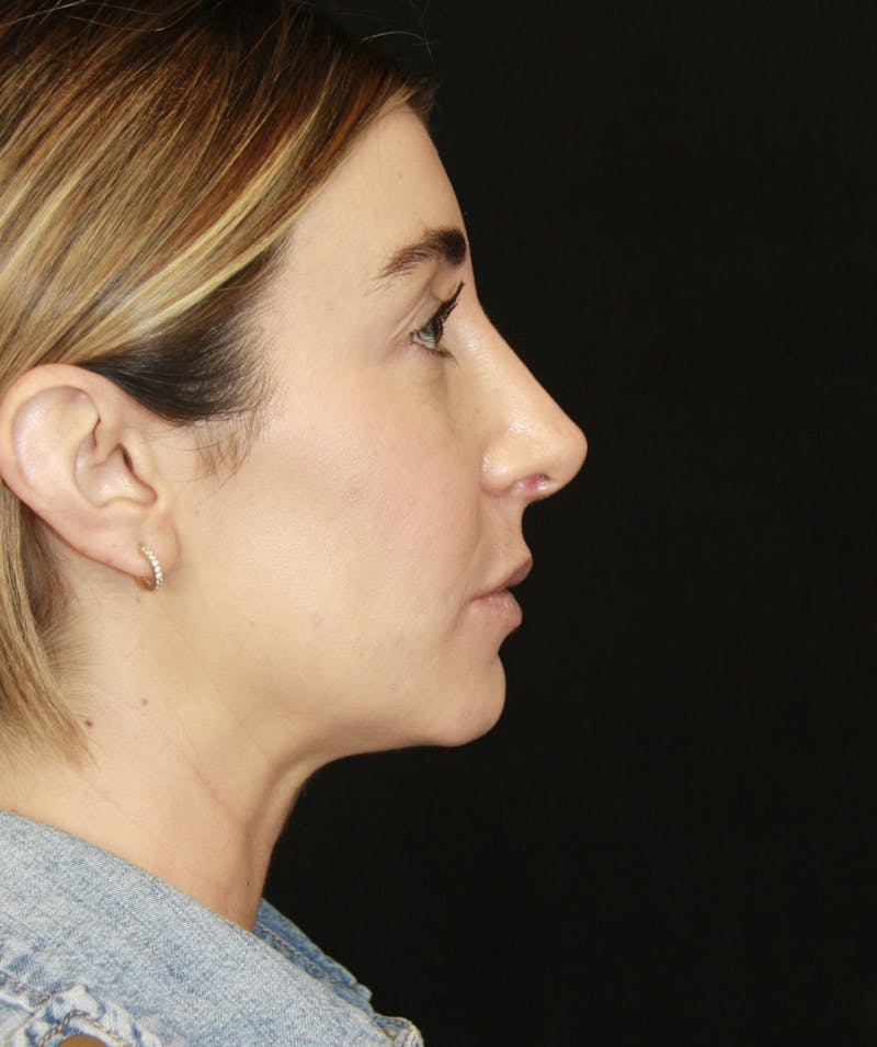 Rhinoplasty Before & After Gallery - Patient 182104693 - Image 6