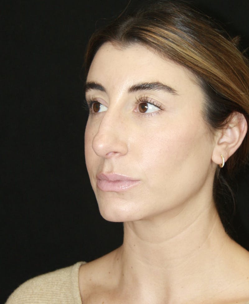 Rhinoplasty Before & After Gallery - Patient 182104693 - Image 7