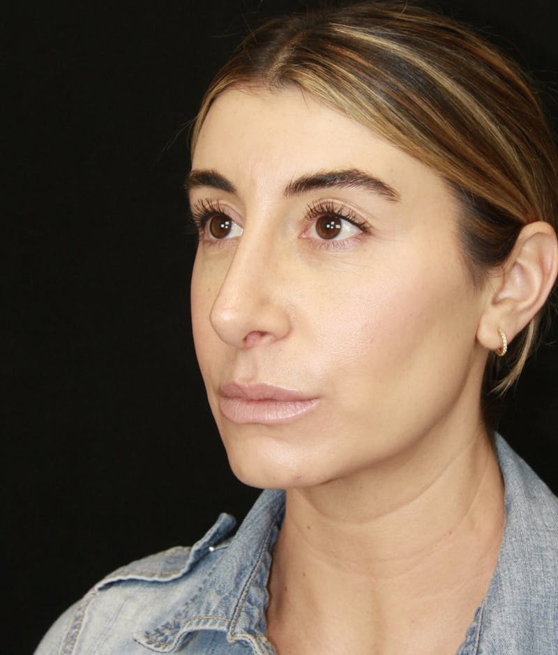 Rhinoplasty Before & After Gallery - Patient 182104693 - Image 8