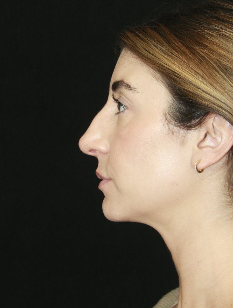 Rhinoplasty Before & After Gallery - Patient 182104693 - Image 9
