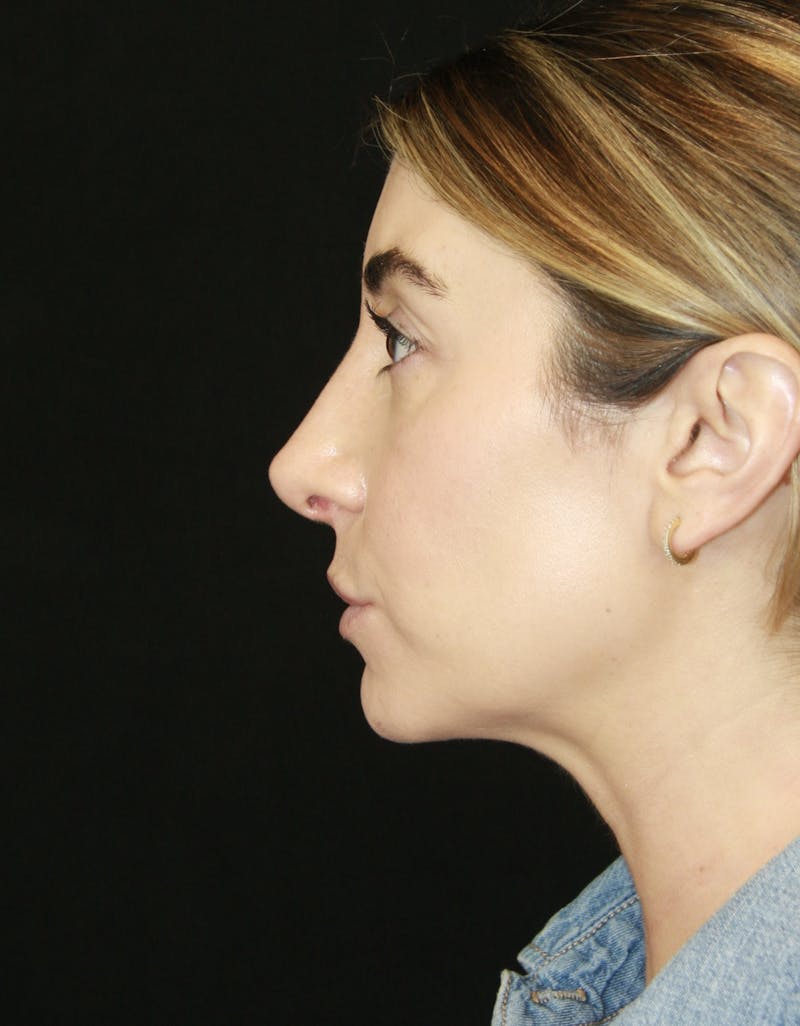 Rhinoplasty Before & After Gallery - Patient 182104693 - Image 10
