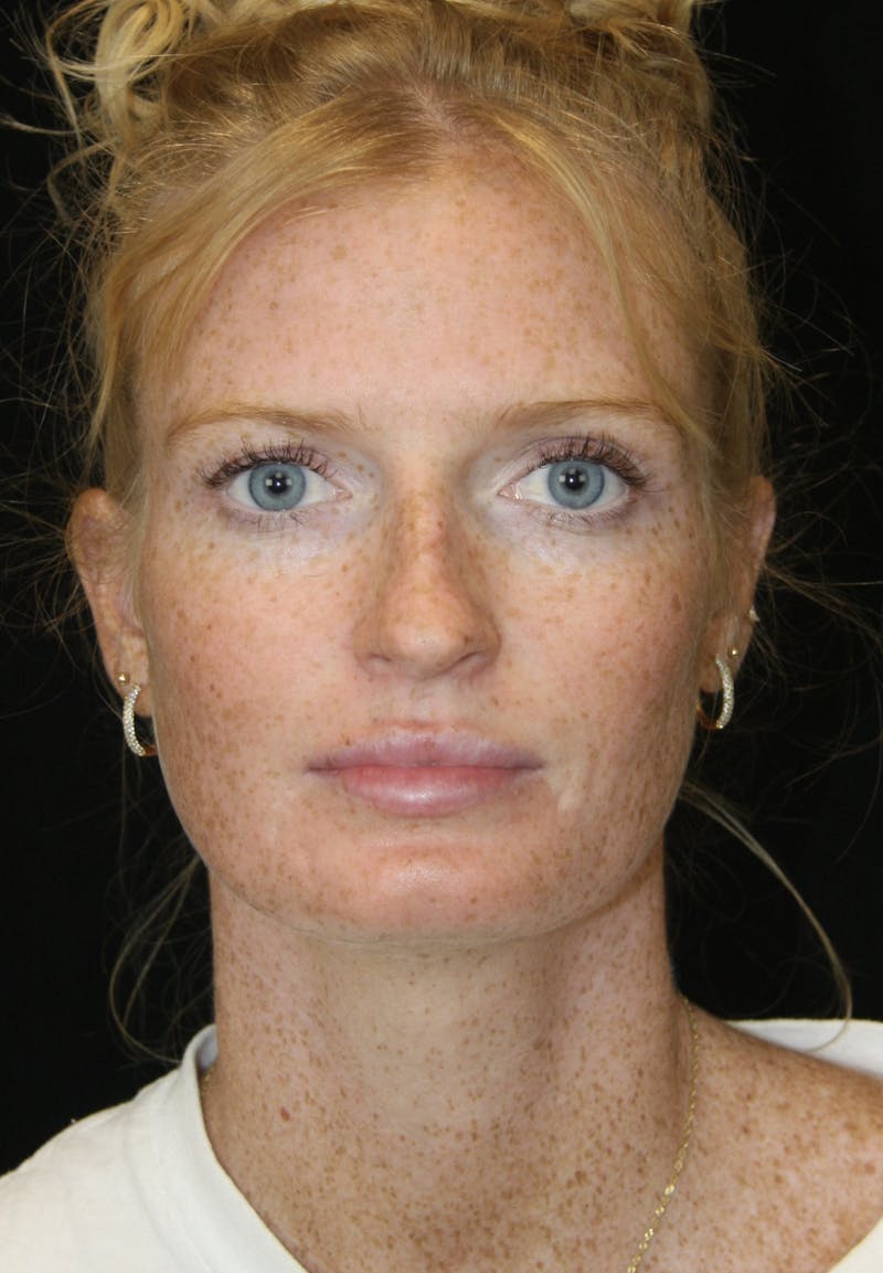 Rhinoplasty Before & After Gallery - Patient 182104717 - Image 1