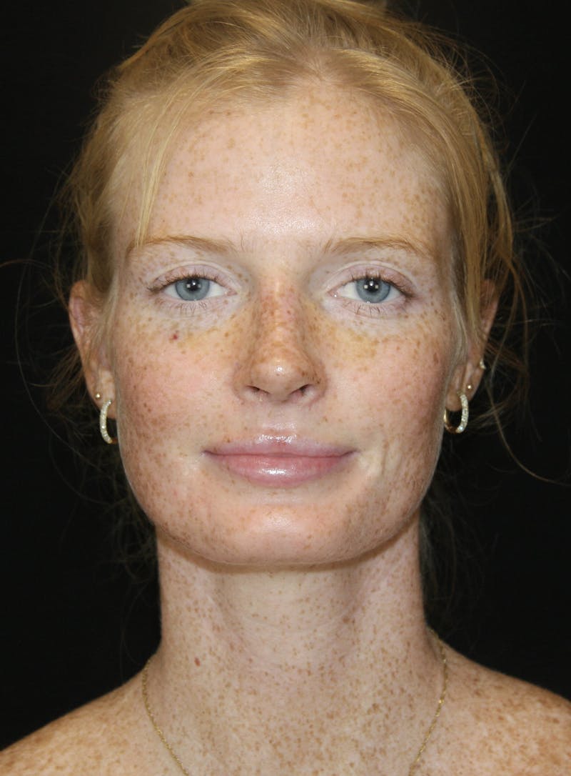 Rhinoplasty Before & After Gallery - Patient 182104717 - Image 2