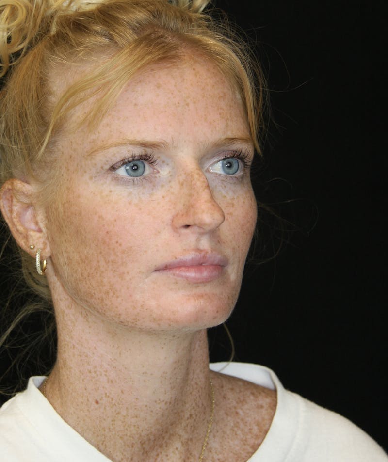 Rhinoplasty Before & After Gallery - Patient 182104717 - Image 3