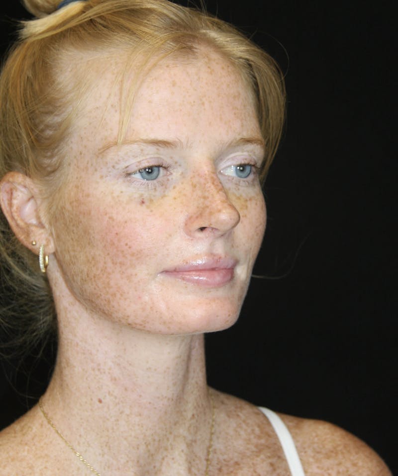 Rhinoplasty Before & After Gallery - Patient 182104717 - Image 4