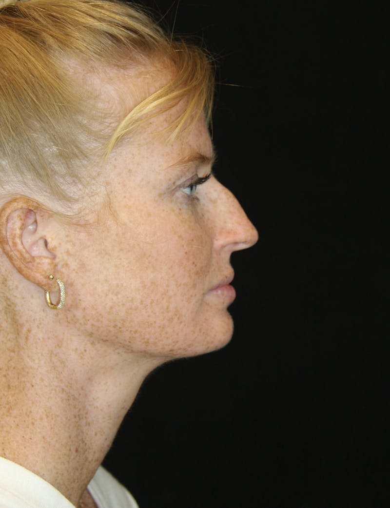 Rhinoplasty Before & After Gallery - Patient 182104717 - Image 5