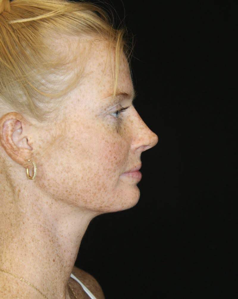 Rhinoplasty Before & After Gallery - Patient 182104717 - Image 6
