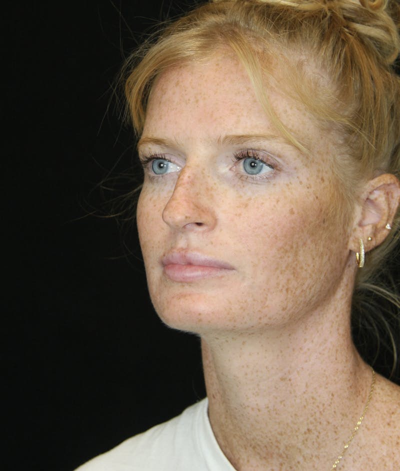 Rhinoplasty Before & After Gallery - Patient 182104717 - Image 7