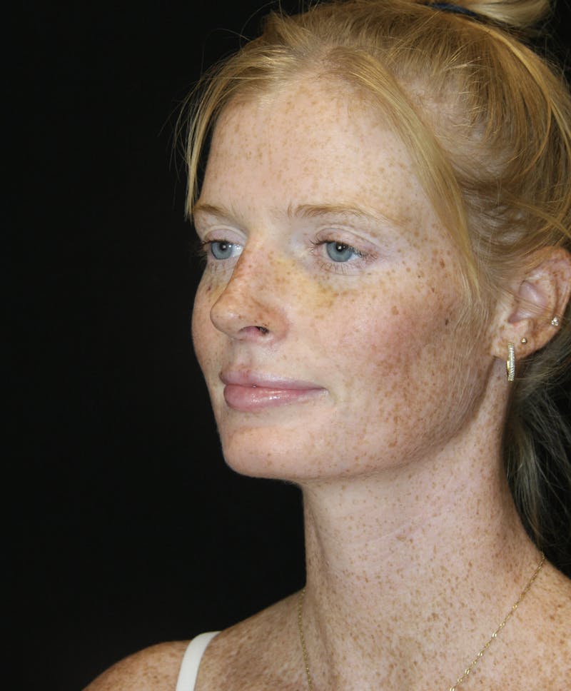Rhinoplasty Before & After Gallery - Patient 182104717 - Image 8