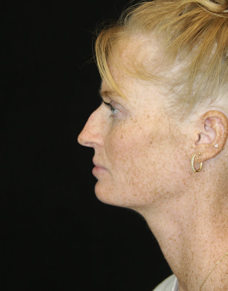 Rhinoplasty Before & After Gallery - Patient 182104717 - Image 9