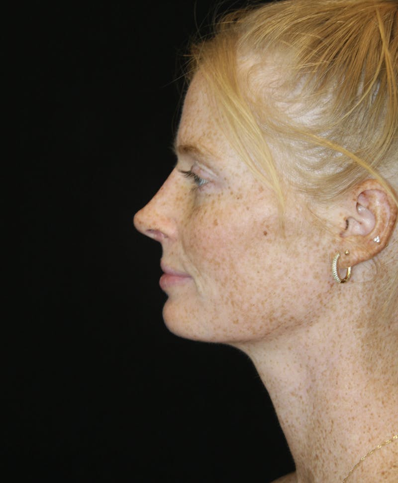 Rhinoplasty Before & After Gallery - Patient 182104717 - Image 10