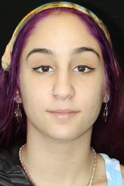 Rhinoplasty Before & After Gallery - Patient 182104745 - Image 1
