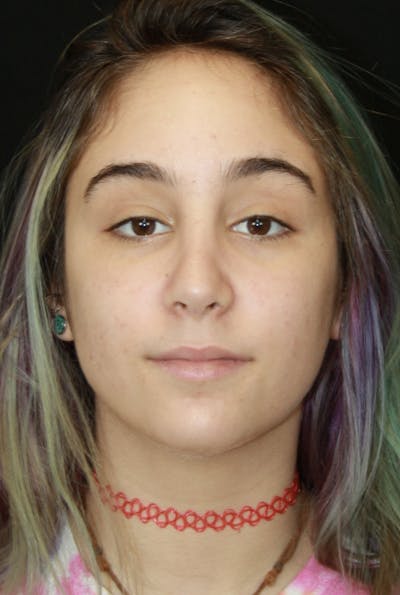Rhinoplasty Before & After Gallery - Patient 182104745 - Image 2