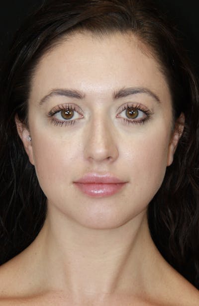 Rhinoplasty Before & After Gallery - Patient 182104816 - Image 1