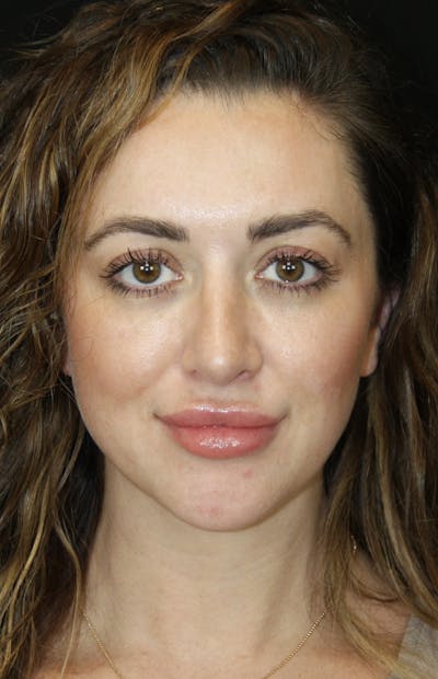Rhinoplasty Before & After Gallery - Patient 182104816 - Image 2