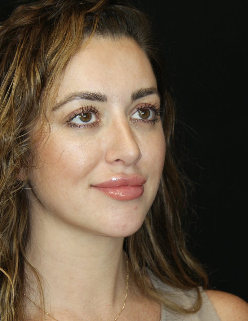 Rhinoplasty Before & After Gallery - Patient 182104816 - Image 4