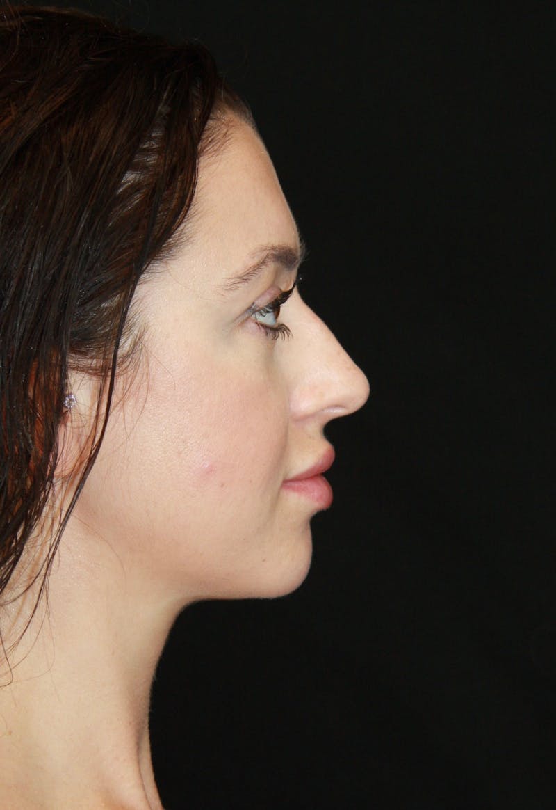 Rhinoplasty Before & After Gallery - Patient 182104816 - Image 5