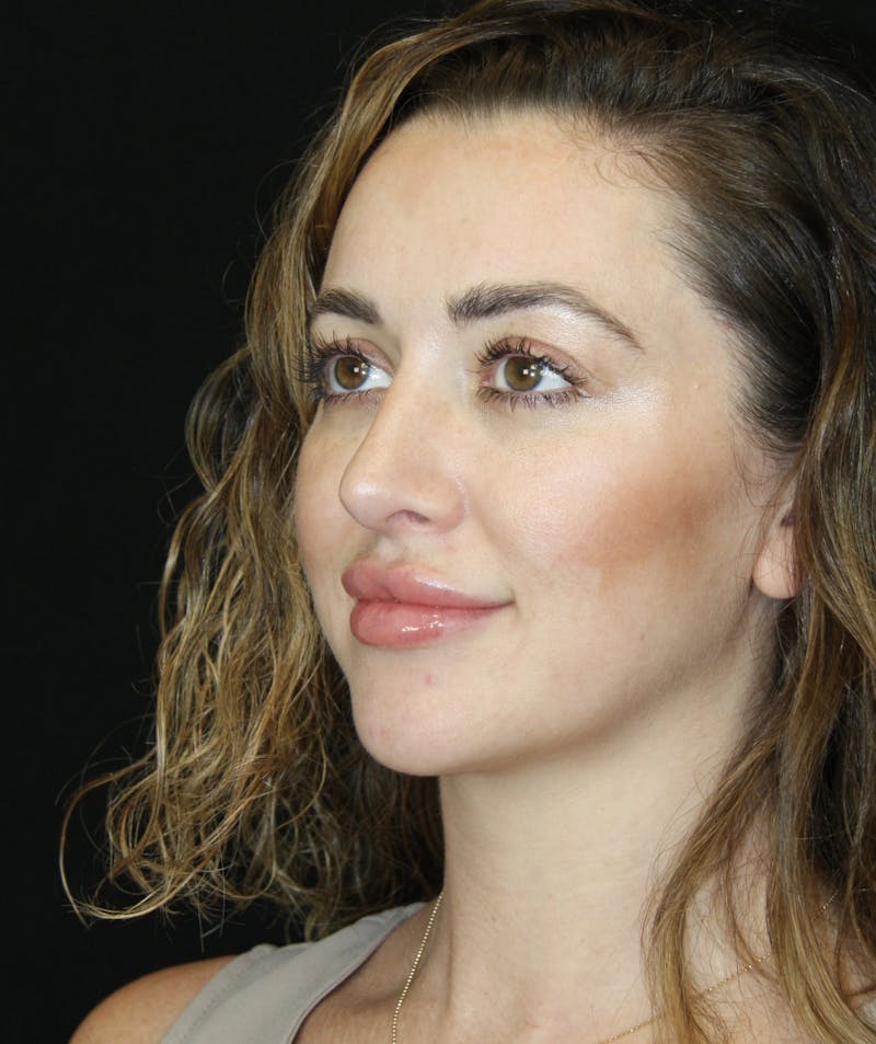 Rhinoplasty Before & After Gallery - Patient 182104816 - Image 8