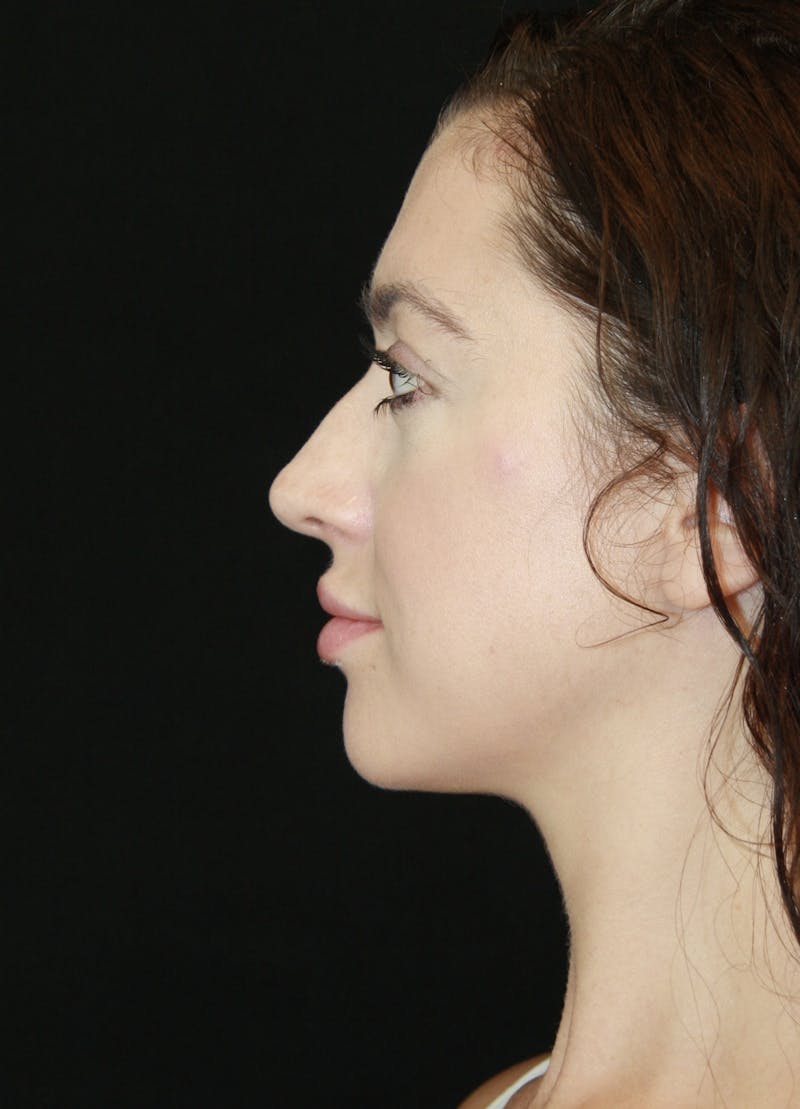 Rhinoplasty Before & After Gallery - Patient 182104816 - Image 9