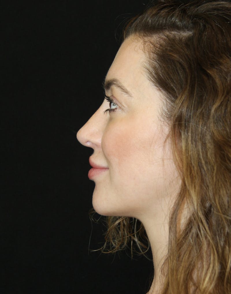 Rhinoplasty Before & After Gallery - Patient 182104816 - Image 10
