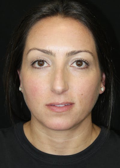 Rhinoplasty Before & After Gallery - Patient 182104893 - Image 1