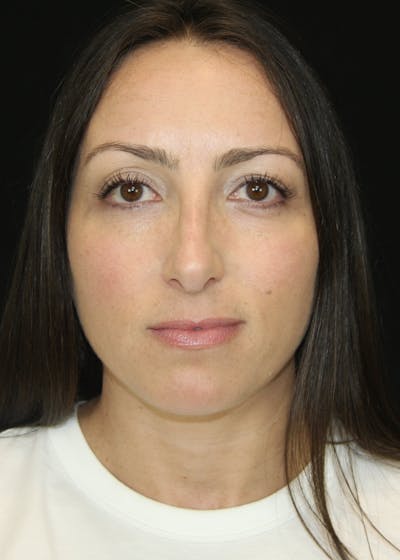 Rhinoplasty Before & After Gallery - Patient 182104893 - Image 2