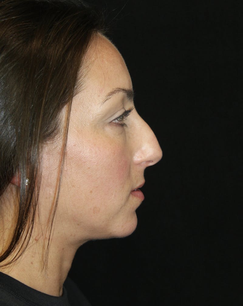 Rhinoplasty Before & After Gallery - Patient 182104893 - Image 3